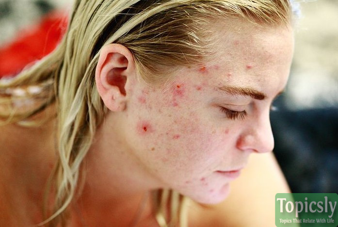 face-wash-making-acne-worse-learn-the-absolute-facts